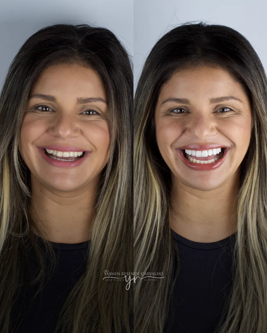 Sorriso de paciente antes e depois do tratamento com a Dra. Yasmin Resende