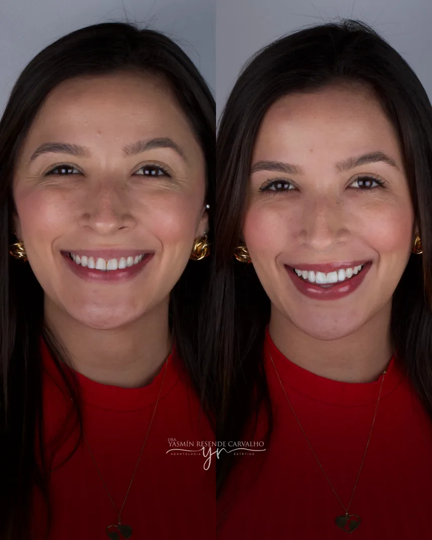 Sorriso de paciente antes e depois do tratamento com a Dra. Yasmin Resende