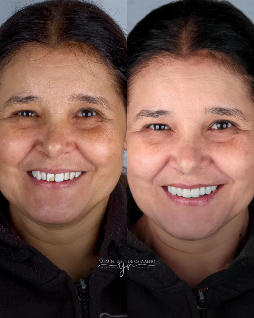 Sorriso de paciente antes e depois do tratamento com a Dra. Yasmin Resende