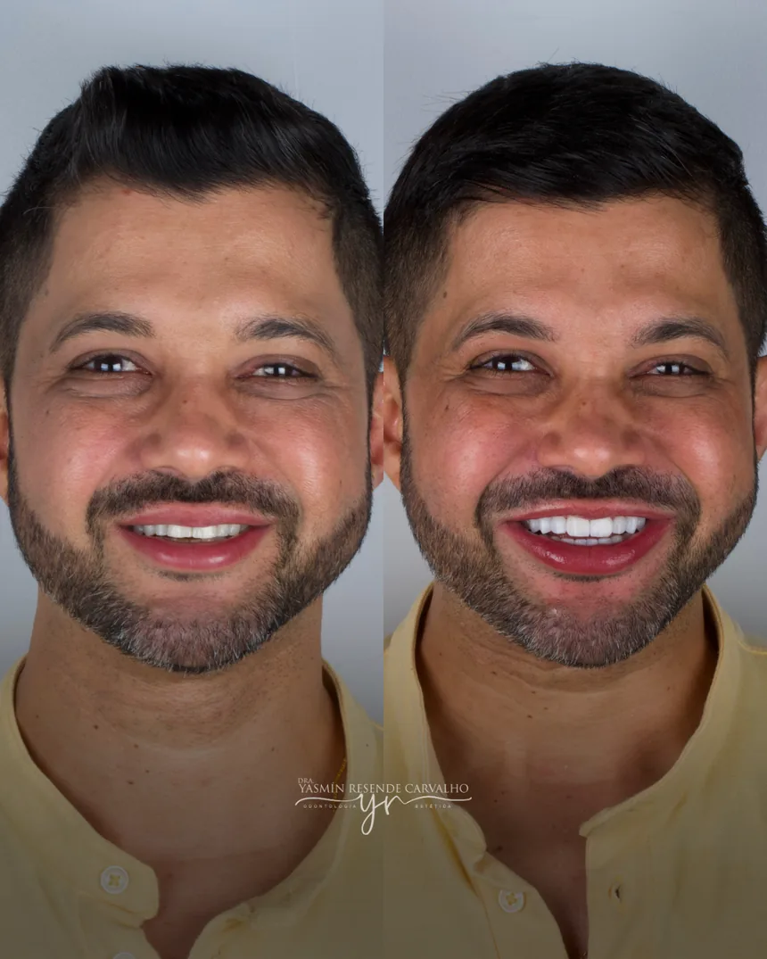 Sorriso de paciente antes e depois do tratamento com a Dra. Yasmin Resende